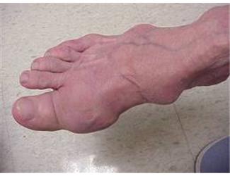 VISION - KẾT QUẢ BỆNH GOUT, Ù TAI, TIỂU ĐÊM